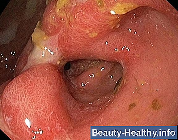 Colonitis Symptoms