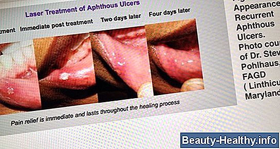 Stages of Cold Sores