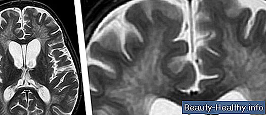 Supratentorial White Matter Disease