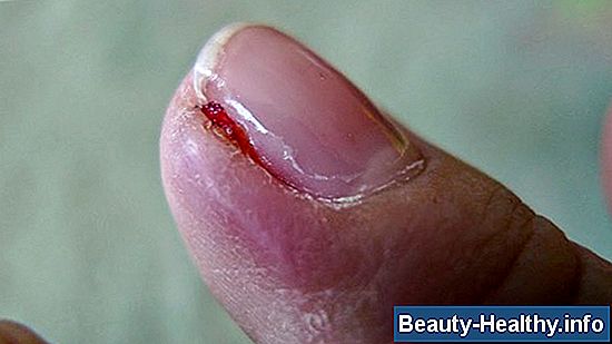 Infected Toe Treatment