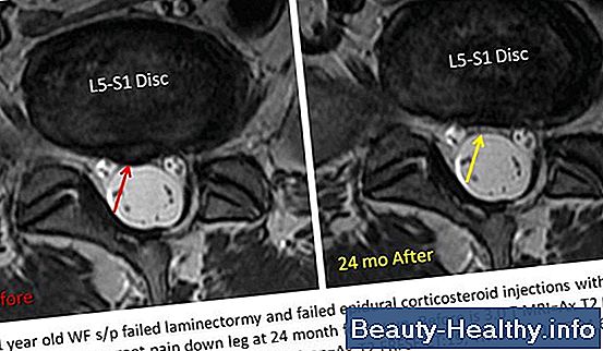 Bulging Disc Treatment