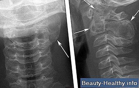 Carotid Artery Pain