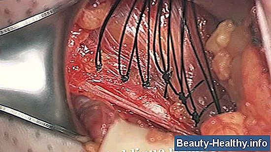 Hernia Mesh Repair Complications