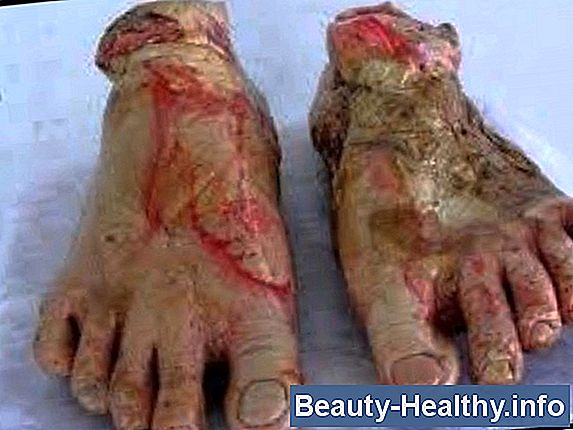 Osteoarthrosis vs. L'osteoartrite