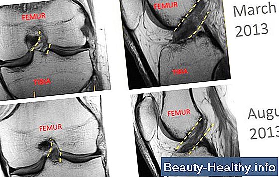 Recovery Time for Hip Surgery