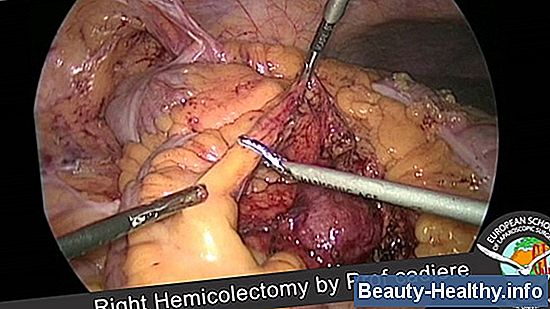Colectomy pikaajaline mÔju
