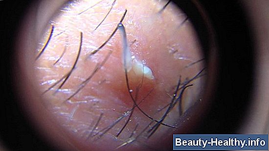 Popping Ingrown Hairs