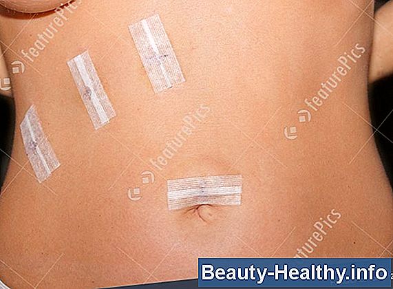 Post-Gallbladder Surgery Soovitatav dieet