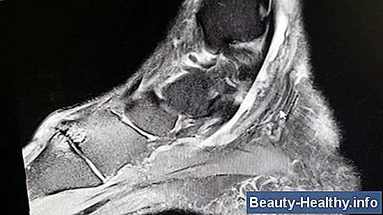 Flexor Hallucis Longus Tendon valu leevendamine