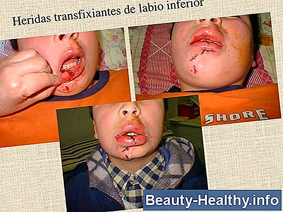 Cómo evitar la mordedura de la rueda del patín