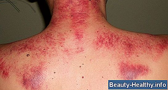 C贸mo aliviar un rigidez en el cuello al estirar el m煤sculo esternocleidomastoideo