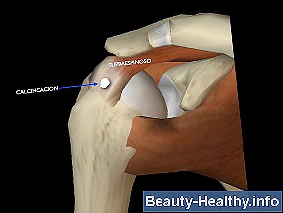 Ejercicios de rehabilitaci贸n de lesiones del manguito rotador