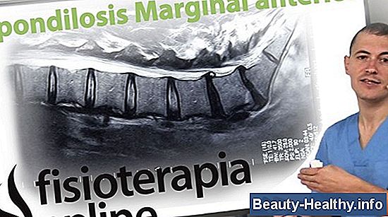 Ejercicios para la espondilosis cervical
