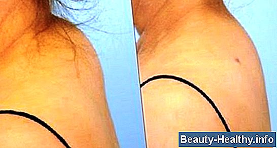 El cuello se estira para eliminar nudos