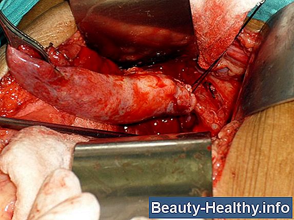Causas del dolor abdominal del lado derecho