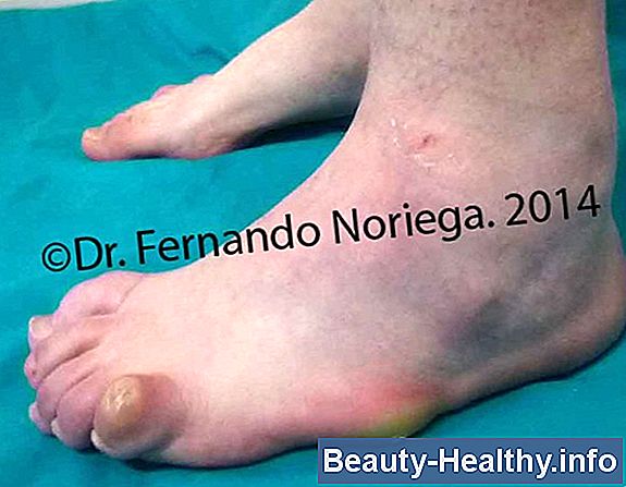 Cómo arreglar el dolor del nervio ciático