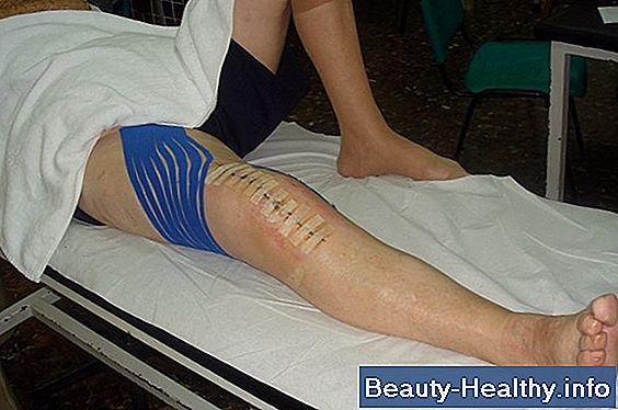 Cómo aumentar la flexión después del reemplazo total de rodilla
