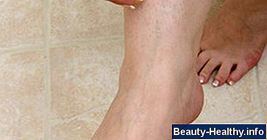 C贸mo reducir el l铆quido en la rodilla