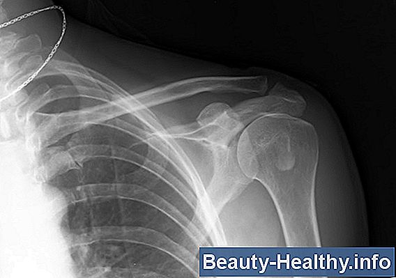 Diagnóstico de fracturas de hombro