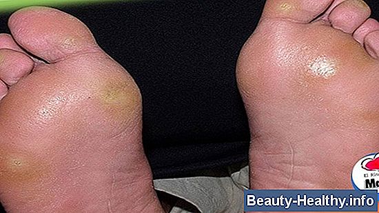 Dolor en el pie de bola