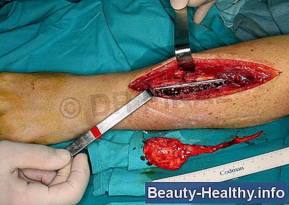 Ejercicios de mano y brazo Post fractura de la cabeza radial