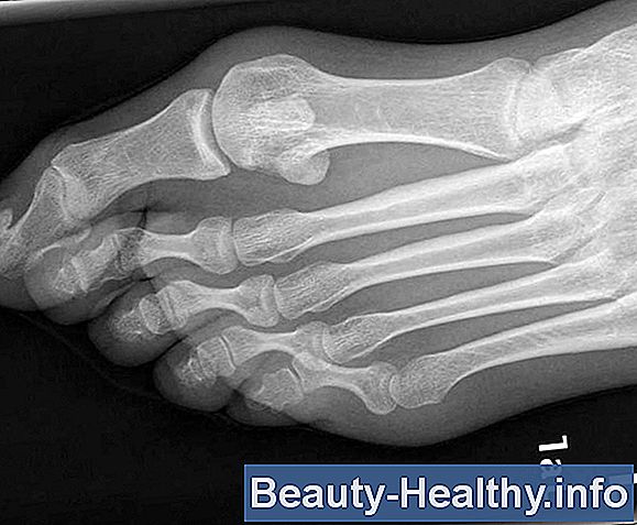 Hallux Rigidus Toe Surgery Tiempo de recuperación