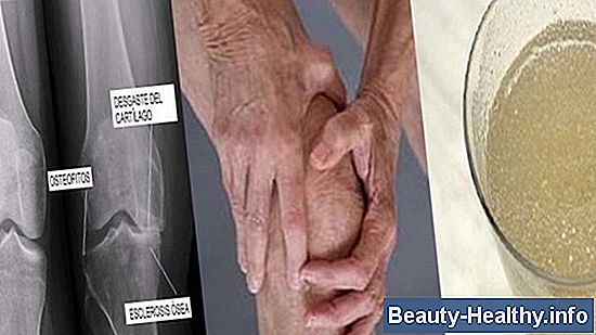 La mejor manera de obtener rodillas nuevamente después de un reemplazo de rodilla