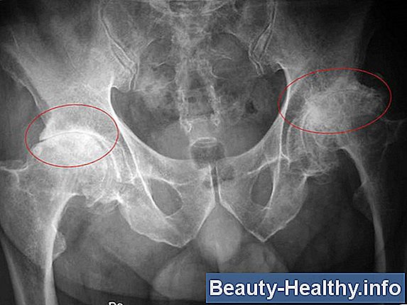 Osteoartrosis vs. Osteoartritis