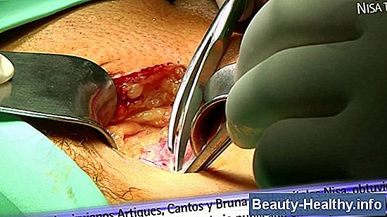 Qué esperar después de la cirugía de hernia inguinal