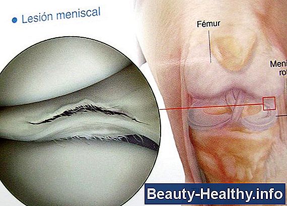Recuperación de la cirugía de verruga plantar