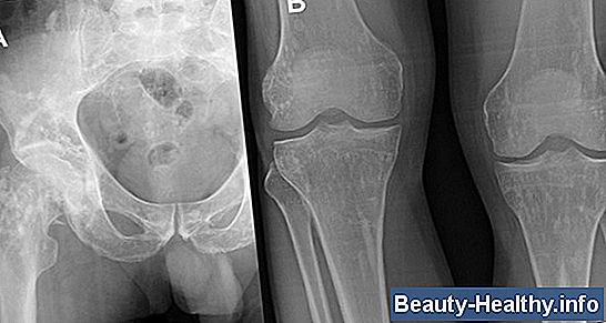 Reemplazo de rodilla y complicaciones del nervio ciático
