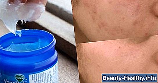Remedio casero para un nervio pellizcado en el cuello