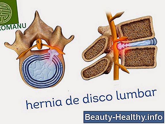 Tiempo de recuperación para la cirugía de hernia