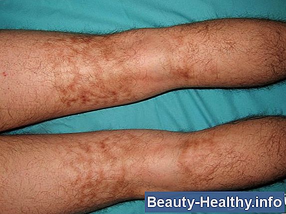 Tratamiento para el derrame de rodilla