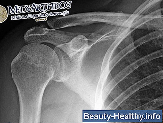 Tratamientos para tendinitis de cuello