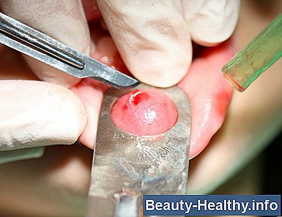 Cómo curar una infección de levadura de tordo oral naturalmente