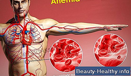 Anemia sintomática