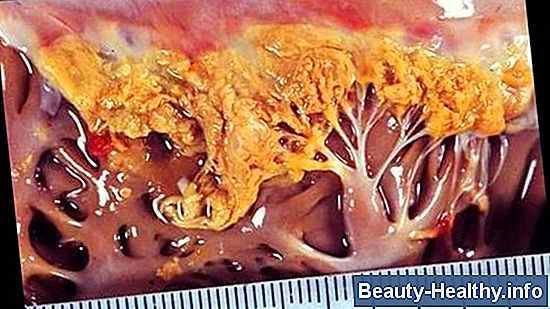 Causas de la infecci贸n por Staph en el cabello