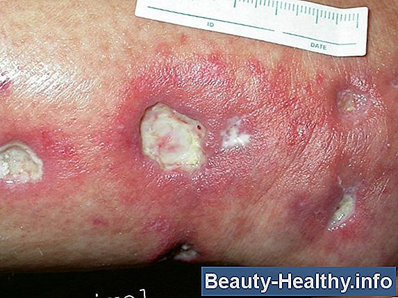 Causas de los nódulos pulmonares