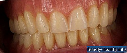Cómo ajustar a las dentaduras inferiores