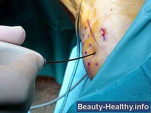 C贸mo aplicar Steri Strips