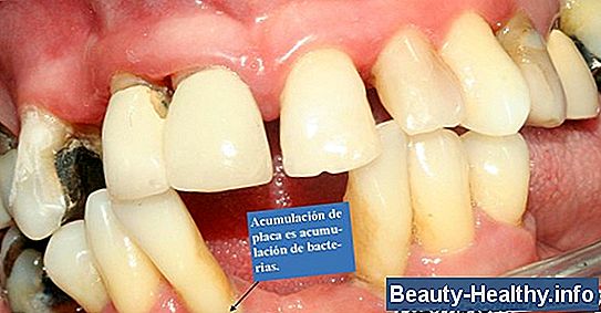 C贸mo arreglar dientes podridos