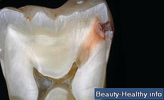 C贸mo arreglar un diente que se cay贸 de las dentaduras