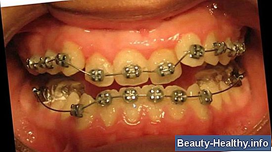 C贸mo corregir una mordida incorrecta de la dentadura