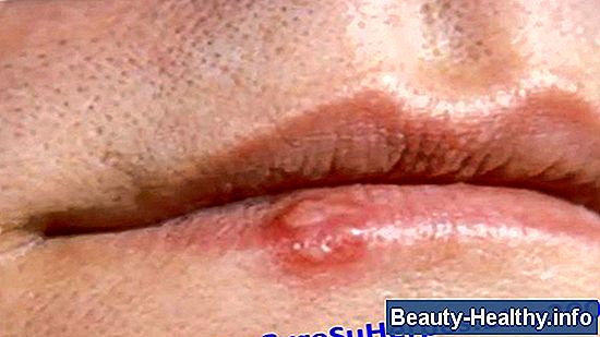 Cómo curar el herpes labial durante la noche