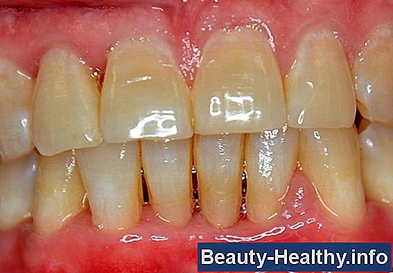 Cómo curar la enfermedad periodontal