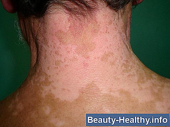 C贸mo deshacerse de la condici贸n de la piel de Tinea Versicolor (pitiriasis versicolor)