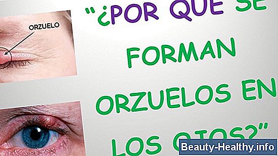 Cómo deshacerse de un orzuelo