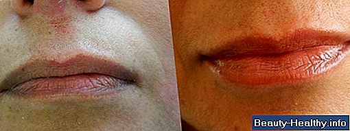 Cómo deshacerse de una herpes labial en 24 horas
