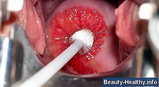 ¿Cómo el cáncer de cuello uterino mata a una persona?